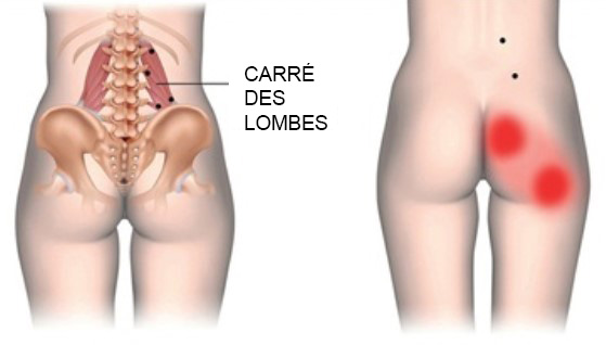 Points gachettes carré des lombes, muscle responsable du mal de dos