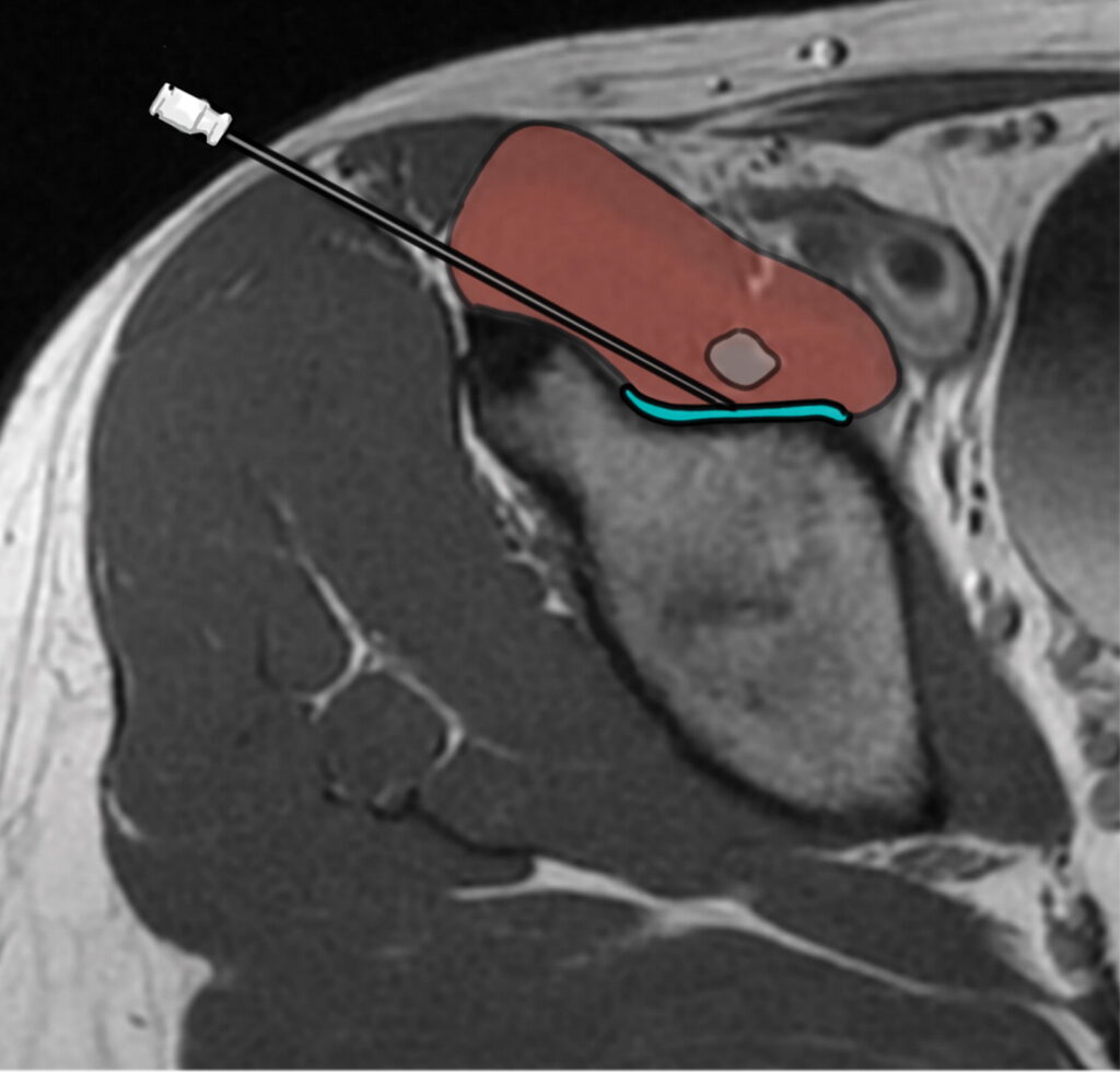 Infiltration pour bursite et tendinite du psoas