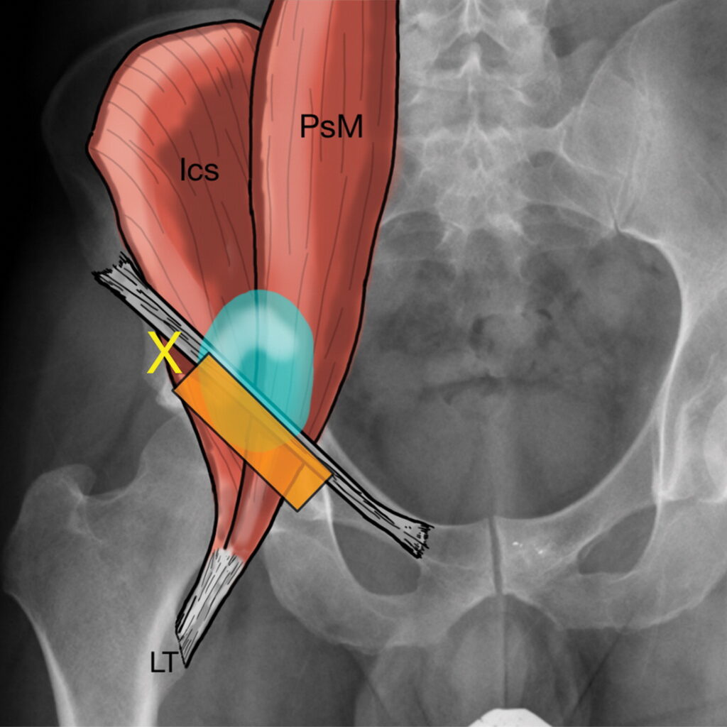 Infiltration bursite tendinite du psoas