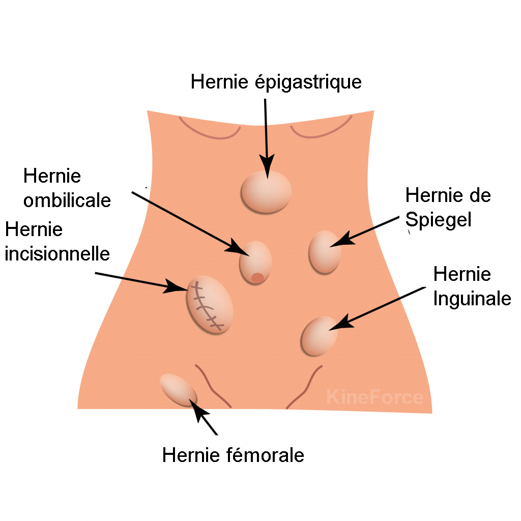Prévenir et traiter les hernies abdominales ? 9 astuces testées