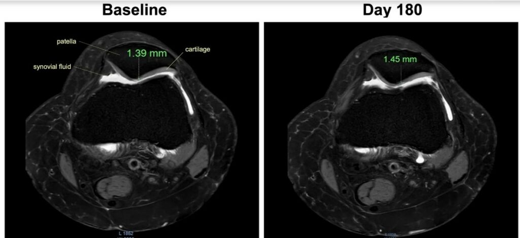 Images radios montrant comment la Boswellia favorise la croissance du cartilage en 6 mois