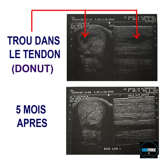 Ultrasons - régénération du tendon d'un cheval en 5 mois