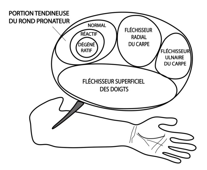 Schéma d'une tendinite des muscles de l'avant-bras